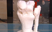 3D打印应用于腕中关节置换术